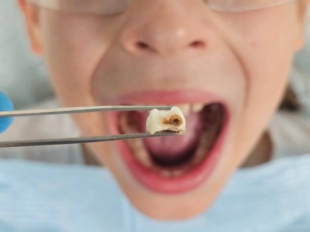 Best Chipped Tooth Repair Near Me  in Paden City, WV